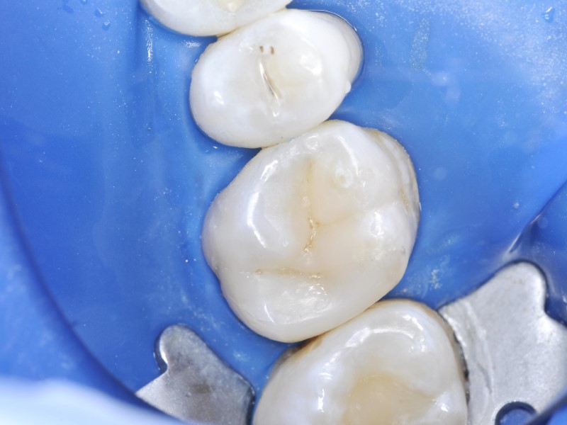 Estetyczne odbudowy zębów Siedlce