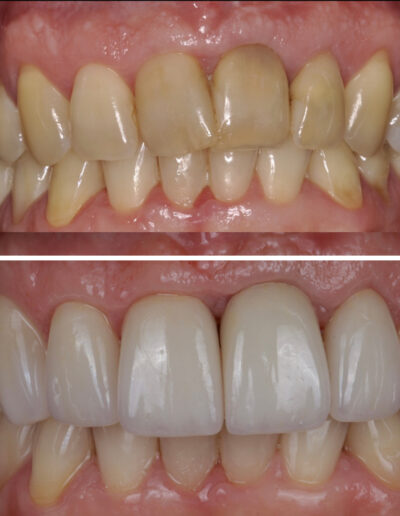 Wybielanie zębów Siedlce