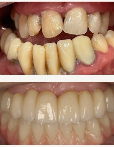 Wybielanie zębów Siedlce