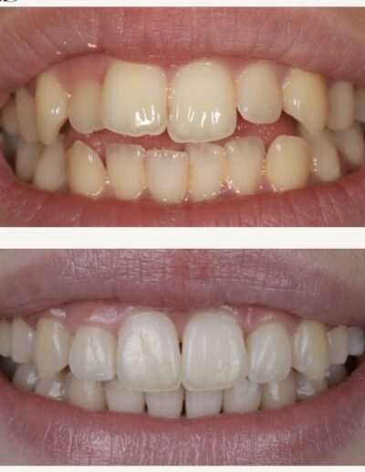 Odbudowa uśmiechu Siedlce